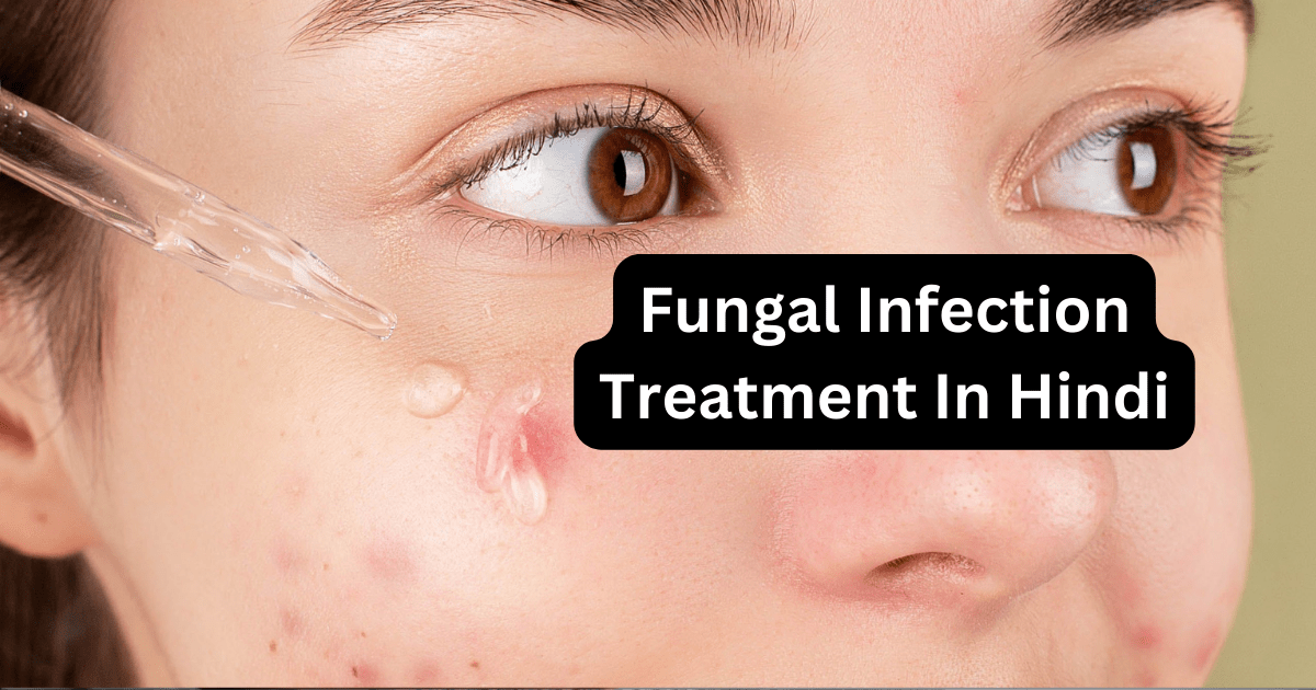 Fungal Infection Treatment In Hindi